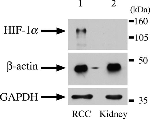 Figure 2. HIF1α expression in a HLRCC renal tumour by immunoblotting. Lane 1 represents total cellular lysate of type II papillary renal cell cancer from HLRCC patient. Lane 2 represents normal kidney. Bands corresponding to HIF-1α (120 kDa) and loading controls (GAPDH, 38 kDa and β-actin, 44 kDa) are arrowed.