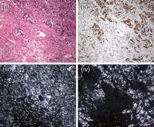 Figure 3. Representative expression of HIF1α and its target molecule VEGF in HPGL paragangliomas. SDHB HPGL paraganglioma (×10) showing H&E (i), HIF1α immunohistochemistry ×10 (ii), β-actin mRNA expression (iii) and VEGF mRNA expression (iv). Note the strong spatial association between the strong nuclear HIF1α staining and the VEGF expression in the tumour cells within ‘Zellballen’.