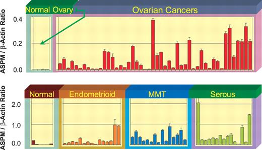 Figure 2. Expression of ASPM in ovarian and uterine cancers. ASPM expression was determined in gynecologic tissue biopsies using real-time PCR. Samples of normal ovary (n=4), ovarian cancer (n=48), normal endometrium (n=6), endometrioid endometrial cancer (n=15), mixed mesodermal tumors of the uterus, MMT, (n=15) and serous endometrial carcinomas (n=15) were analyzed. ‘Normal’ for uterine cancers is normal endometrium.