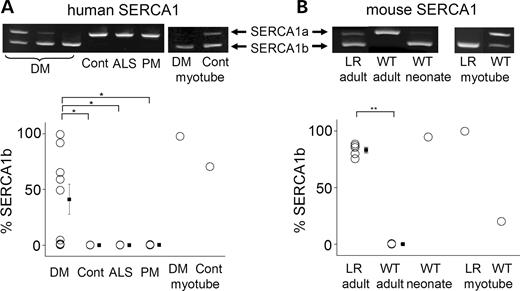 Figure 3. Analysis of SERCA1 splice variants shows an increase in SERCA1b in DM1. (A)Top: RT–PCR analysis of endogenous SERCA1 mRNA from skeletal muscle tissues of DM1 (DM), normal control (Cont), ALS and PM patients. PCR products from SERCA1a (+exon 22) and SERCA1b (−exon 22) are 259 and 217 bp, respectively. Bottom: The mean percentages of human SERCA1b isoform: *P<0.01. (B) RT–PCR analysis of endogenous SERCA1 mRNA from skeletal muscle tissues of adult and neonatal muscle obtained from WT and HSALR (LR) mice. Top: PCR products from SERCA1a (+exon 22) and SERCA1b (−exon 22) are 243 and 201 bp, respectively. Bottom: The mean percentages of mouse SERCA1b isoform: **P<0.0001.