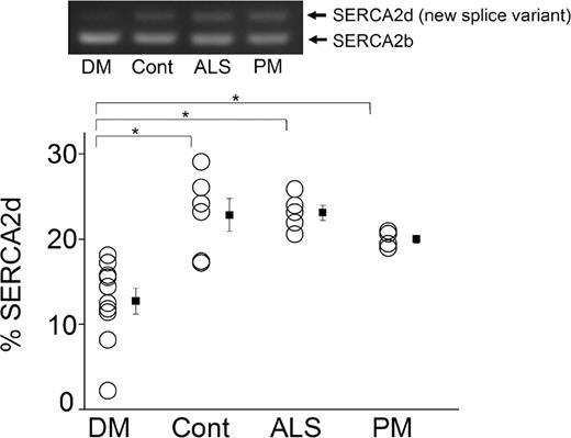 Figure 4. No changes in SERCA2b variants but reduced expression of a novel splicing isoform, SERCA2d, in DM1 muscle. Top: Representative RT–PCR analysis of endogenous SERCA2b mRNA from skeletal muscle tissues of DM1 (DM), normal control (Cont), ALS and PM patients. RT–PCR was analyzed using a primer to the flanking exon 19 and 20. The PCR product from SERCA2b is 325 bp. A novel splicing variant (SERCA2d, with the inclusion of intron19) is 407 bp. Bottom: The mean percentages of SERCA2d isoform: *P<0.01.