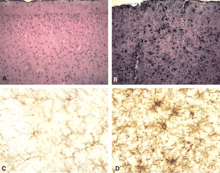 Figure 4. Reactive astrocytes and microglia in GFAP transgenic mice. Immunohistochemical staining for GFAP shows a dramatic difference in astrocyte morphology and in the apparent expression of the intermediate filament in the GFAP transgenic mice compared with wild-type at 3 months of age. The wild-type mice (A) show only sparse staining of subpial and perivascular astrocytes in the cortex, whereas the transgenic mice (B) demonstrate intensely stained hypertrophied astrocytes throughout (100×). Immunohistochemical staining with Mac1 antibodies (anti-Cd11b) shows a marked increase in expression in Tg73.7 mice (4 months). Microglia are present in wild-type olfactory bulb (C), but are ramified and not activated. Microglia in Tg73.7 olfactory bulb (D) show intense Mac1 staining and have a hypertrophied morphology (400×).