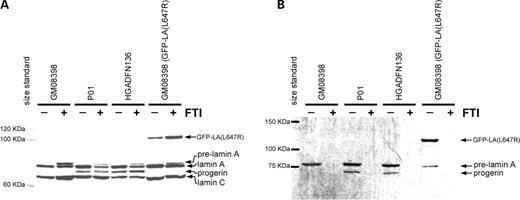 Figure 1. Normal (GM08398) and HGPS (P01 and HGADFN136) fibroblasts were plated in T25 flasks. One flask of each line was labeled with 3H-mevalonate (125 µCi/ml) and mevinolin (25 µm). Cells were lysed in the flask with RIPA and 300 µg of cellular protein was immunoprecipitated with lamin A/C antibodies. Protein levels prior to immunoprecipitation are displayed in (A). Fluorography (B) of the immunoprecipitated proteins shows a unique band, progerin, in the HGPS lines demonstrating that progerin is farnesylated. Addition of 2 µm FTI (+) causes accumulation of pre-lamin A (A) and completely prevents incorporation of the 3H-labeled farnesyl precursor (B). Normal fibroblasts expressing an uncleavable form of lamin A (GFP–LA (L647R)) that remains farnesylated were included as a positive control.