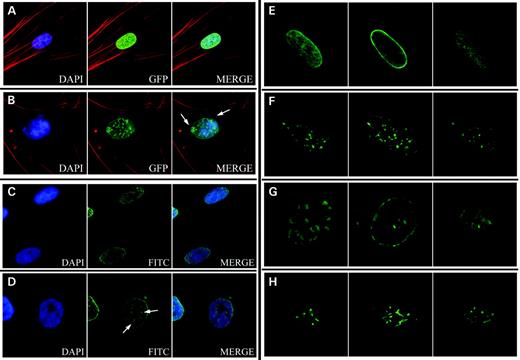 Figure 2. Localization of transiently-expressed GFP–lamin A and GFP–progerin. GFP–lamin A was evenly distributed around the nuclear periphery (A), whereas expression of GFP–progerin formed aggregates at the nuclear periphery and caused blebbing (arrows) (B). Immunocytochemistry using a lamin A-specific antibody to detect localization of endogenous lamin A is shown for normal (C) and HGPS (D) fibroblasts. Lamin A aggregates were observed in HGPS fibroblasts (arrows) (D). Images in (A) through (D) show focal planes at the near side of the nucleus. Signals were obtained with a Zeiss Axiophot Fluorescent microscope with a Sensys CCD camera and Applied Imaging digital imaging capture software. Localization of GFP–lamin A (E and F) and progerin (G and H) was analyzed using a Zeiss LSM 510 confocal microscope mounted on a Zeiss Axiovert 100M inverted microscope. Three focal planes are shown: top, middle and bottom (from left to right). These images show the location of the GFP–progerin aggregates as thicker regions at the nuclear periphery (G). Fibroblasts expressing normal GFP–lamin A have GFP signal around the nuclear periphery (E). Exposure to 100 nm FTI (PD169451) for 72 h caused a redistribution of the GFP–lamin A signal (F) and GFP–progerin (H) to intranuclear structures.