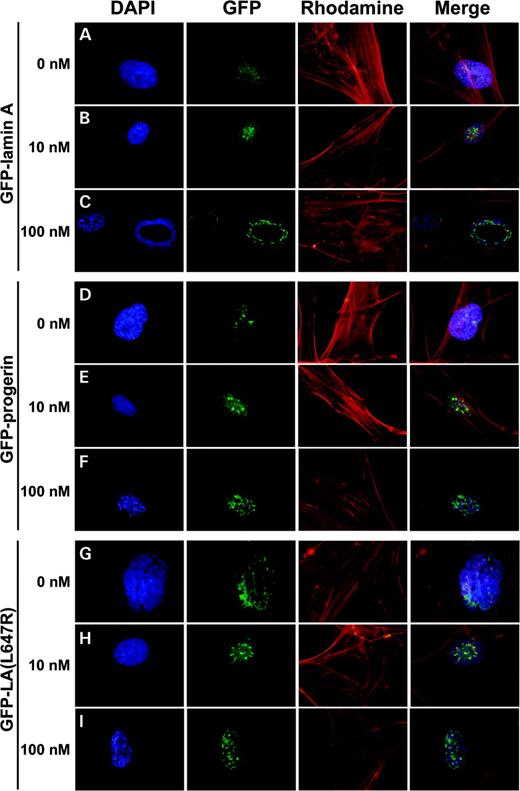 Figure 5. The effect of FTI on the distribution of GFP signal in normal fibroblasts (GM08398) expressing GFP–lamin A (A, B and C), GFP–progerin (D, E and F) and GFP–LA (L647R) (G, H and I) using a retroviral Tet-off system with various FTI concentrations. Fibroblasts were maintained in medium with 0 nm (A, D and G), 10 nm (B, E and H) or 100 nm (C, F and I) FTI for six days. Expression levels of the GFP fusions were maintained at levels similar to endogenous levels of lamin A by the addition of 0.05 mg/ml tetracycline. Signals were visualized with a Zeiss Axiophot Fluorescent microscope and imaging was performed using the Olympus DP70 Digital Camera System.