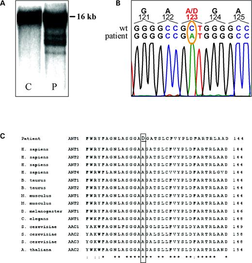 Figure 2. Molecular findings. (A) Southern blot of PvuII-linearized mtDNA from skeletal muscle. lane C: control sample; Lane P: patient's sample. In both lanes, a 16.5 kb band corresponds to wt mtDNA; in the patient's sample, additional smaller bands correspond to deletion-containing mtDNA molecules. (B) Sequence analysis of the DNA region encompassing the homozygous 268C→A transversion in the ANT1 gene of the patient. (C) Alignment of the primary structure of known mitochondrial ADP/ATP carriers. The conserved alanine mutated in the patient is boxed. For sequence alignment version 1.4 of ClustalW was used with default parameters. Asterisks denote conserved residues. Double dots indicate conservatively substituted residues.