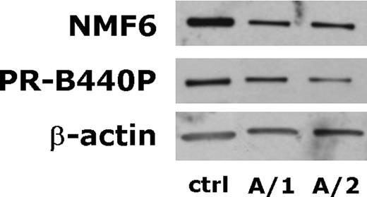 Figure 4. Representative immunoblots of granulocyte NMMHC-IIA. Granulocytes from family A were isolated from PB and finally lysed in ice-cold lysis buffer as described in Materials and Methods. Proteins were separated on a 5–15% acrylamide gel, transferred to nitrocellulose and probed with NMF6 and PR-B440P Abs anti-NMMHC-IIA and AC-15 Ab anti-β-actin. The figure shows an evident reduction of the expression of wild-type NMMHC-IIA in granulocytes from the representative patients A/1 and A/2. A similar reduction was detected with both the NMF6 Ab (recognizing both wild-type and mutant proteins) and PR-B440P Ab, whose epitope is deleted in the mutant NMMHC-IIA. 