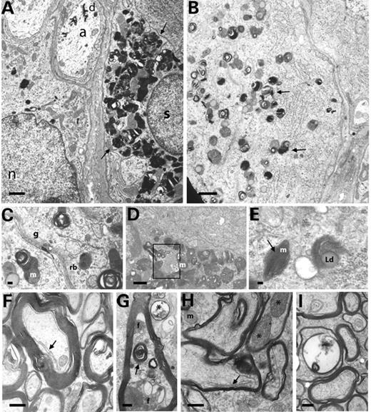 Figure 4. Pathological features on DRG cells in aldr−/− mice at 20 months of age. (A) High number of zebra bodies filling up a satellite cell (s). a: axon containing electron dense debris; n: ganglion cell nucleus. (B) Polymorphous residual and zebra-like bodies in cytoplasm of a ganglion cell (arrows). (C) Abnormal mitochondria with a lipid droplet and circular cristae in a ganglion cell (m). Fragmentation of Golgi cisternae (g). rb: residual body. (D) Mitochondria containing lipidic residual bodies in satellite cells. (E) In a ganglionar cell, mitochondria (m) with paracristallin profile (arrow) resulting from the juxtaposition of parallel-stacked cristae. In the vicinity, a lipid droplet (Ld) with an accumulation of filamentous, proteinaceous material. (F) Decompactation of axolemma (arrow). (G) Axonal degeneration: involution of the cellular organites with the formation of a fibrillar body (f) and myelin-like bodies (arrow); numerous vacuoles. Empty fiber (asterisk). (H) Myelin remnants in the Schwann cell, resulting in a fibrillar and granular body (f). Axolemma decompactation (arrow). Note two giant mitochondria (asterisks). (I) An empty myelinated fiber containing two myelin bodies. Scale bars: 1 µm (A and B); 0.1 µm (C–E); 0.5 µm (F–I).
