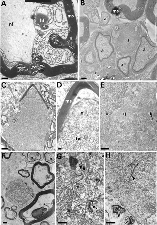 Figure 5. Pathological features in spinal cord, ventral horn gray matter of aldr−/− mice at 20 months of age, except (B). (A) Axonal sprouting within a large axon filled with neurofilaments (nf) surrounded by myelin sheath (ms), lipid droplet (ld). (B) Axonal sprouting consistent with axonal regeneration in sciatic nerve. a: axon; s: Schwann cell nuclei. (C) Dense, degenerating axoplasm focally surrounded by distorted myelin. (D) Higher magnification of the region within the square in (C), showing tubulo-vesicular inclusions (tvi) and fragmented smooth ER (asterisk). ms: myelin sheath. (E) Motor neuron cell body with hypertrophy of abnormal Golgi (g) cisternae associated to fragmented smooth ER (asterisk). Mitochondrial enlargement and densification of cristae (arrows). (F) At the image center, enlargement of a non-myelinated fiber, with accumulation of organelles. Note myelinated degenerating axons, with decompactation of axolemma (asterisk). (G) In neurons, lamellar bodies derived from altered Golgi (g) and rough endoplasmic reticulum (arrows). Note mitochondria with tubular cristae (asterisk) and ring-shaped alteration (white arrow). (H) Remnants of the Golgi apparatus in the form of lamellae (arrows), in a zone with small smooth ER vacuoles. Two lamellated bodies within an axonal fiber (open arrows). Scale bars: 1 µm (A–C, E and F); 0.1 µm (D); 0.5 µm (G and H).