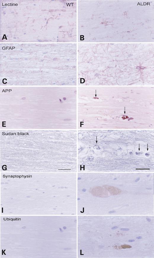 Figure 6. Gliosis, myelin and axonal pathology in spinal cord in aldr−/−. Longitudinal sections of the dorsal spinal cord in wild-type and aldr−/− and control littermates at the age of 20 months, processed for glial GFAP, lectin L. esculentum, APP, Sudan black and synaptophysin. (A–D) Reactive astrogliosis is observed in aldr−/− mice when compared with littermate controls. In (E and F), APP deposits are seen in axonal swellings in aldr−/− mice. This is accompanied by lipidic debris of myelin, as revealed with Sudan black in (G and H). In (I and J), abnormal fibers filled with synaptophysin are found in aldr−/− mice. Synaptophysin and APP deposits are ubiquitinated (K and L).