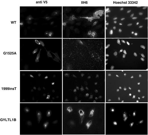 Figure 4. Double-labelling of CHO transfected cultures with anti-V5 (left hand panel) and α-dystroglycan antibody IIH6 (recognizing an unknown glycosylated epitope; middle panel). Right panel shows Hoechst 33342 nuclear staining. Increased IIH6 immunoreactivity is seen with LARGE wild-type (WT) and GLYTL1B constructs. LARGE MDC1D (G1525A and 1999insT) did not alter IIH6 immunoreactivity. Scale bar, 20 µm. 