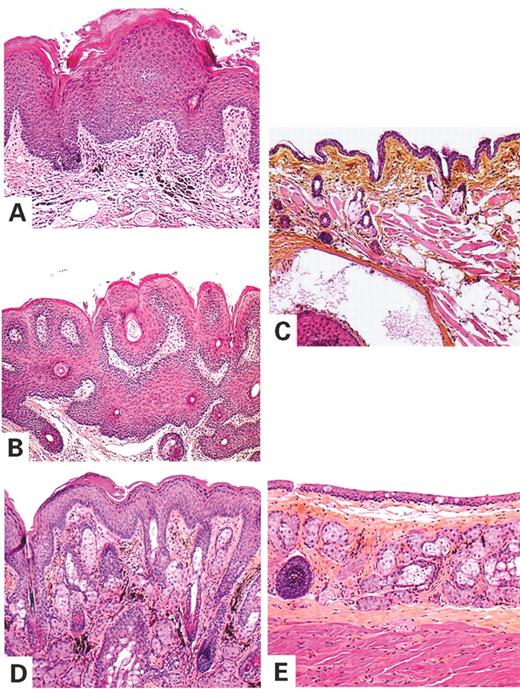 Figure 2. Tumor histology of K5-(S249C)FGFR3 transgenic mouse skin lesions. (A, B and D) Hematoxylin, eosin and saffron sections of skin lesions from the snout (A and B) and the trunk (D) of a transgenic K5-(S249C)FGFR3 mouse. (C and E) Sections of normal snout (C) and trunk (E) from a control littermate are shown for comparison. These skin lesions showed various degrees of acanthosis, papillomatosis and hyperkeratosis. Lesion in (B) is thicker than in (A) and shows interlacing strands (trabeculated aspect) of basaloid and squamous cells enclosing hair follicles. The parakeratosis and spongiosis observed in (A) were probably caused by itching and repetitive scratching of the lesion. Magnification 100×.