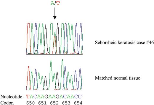 Figure 4. Example of a somatic FGFR3 mutation in a seborrheic keratosis sample. Sequencing revealed a missense mutation in codon 652 (AAG-->ATG) of FGFR3 in DNA from seborrheic keratosis 46 and a wild-type sequence in a normal matched DNA sample.