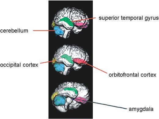 Figure 2. Renderings of a normal human brain, reconstructed from serial magnetic resonance images, showing some of the neuroanatomical structures discussed in this review that are influenced by X-linked genes. Other structures that are discussed, but which are not visible in these images because they lie more deeply in the brain, include the hippocampus, thalamus and caudate nuclei. The amygdala is represented bilaterally and lies deeply in the mesial temporal lobe; it is closely associated anatomically with the hippocampus, the caudate nuclei and the thalamus. Many of these structures comprise elements of the so-called social brain (56,57). Figure originally provided by Deema Fattal and Hanna Damasio, Human Neuroanatomy and Neuroimaging Laboratory, Department of Neurology, University of Iowa, and adapted from Adolphs (56) and reproduced with permission.