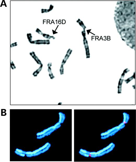 Figure 1. Examples of common fragile sites. (A) Human G-banded metaphase chromosomes with breaks at fragile sites FRA3B and FRA16D (arrows). (B) An example of an SCE at a fragile site. Both homologs of chromosome 3 with breaks at FRA3B were stained to show SCEs. The chromosome at the bottom has an SCE at the fragile site. A yeast artificial chromosome mapping to FRA3B was used as a fluorescence in situ hybridization probe (red) to identify breakage at the fragile site.