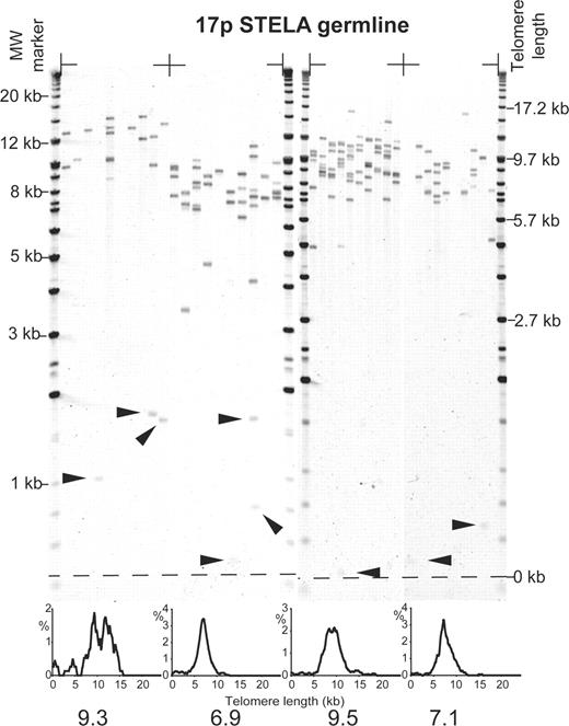 Figure 3. STELA at the telomere of 17p in four unrelated individuals using the 17pseq1rev1 primer, products detected by Southern hybridization with a (TTAGGG)n containing probe. Filled arrows indicate telomeres shorter than 2.33 SDs from the mean of the distribution. Histograms displaying the telomere length distributions, with the modal telomere length are shown below. Molecular weight markers are shown on the left and corrected for telomere length on the right.