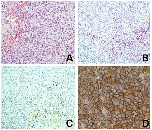 Microscopic features of the Ewing's sarcoma with t(4;19)(q35;q13). (A) The hematoxylin and eosin-stained section shows diffuse proliferation of small round tumor cells (original magnification, 20×). (B) Periodic acid Schiff's staining. The small number of glycogen granules in the cytoplasm are shown (original magnification 20×). (C) Immunohistochemical staining shows that CD99/MIC2 is weakly positive for tumor cells (original magnification, 20×). (D) CD99/MIC2 staining of typical EFT (original magnification, 40×).