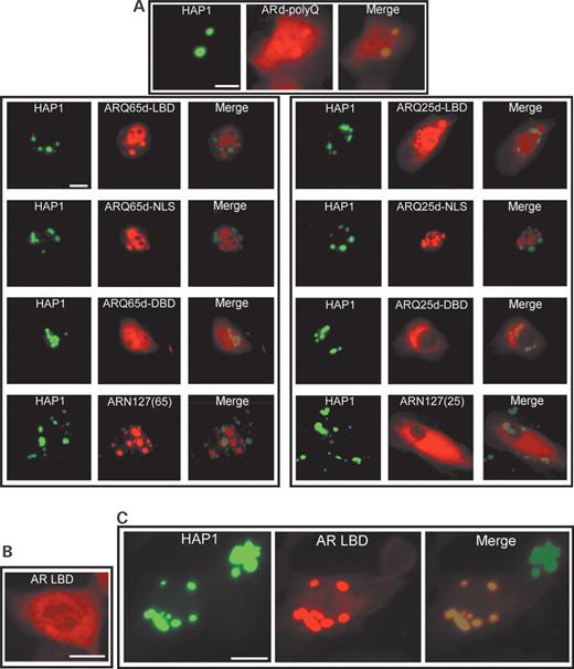  Fluorescent photomicrographs showing subcellular interactions between HAP1 (GFP: green) and several kinds of AR-deletion mutants (Alexa594: red) in transfected HEp-2 cells. ( A ) Subcellular interactions between HAP1 and AR-deletion mutants without polyQ or LBD in their cotransfection. Note that ARd-polyQ without polyQ shows clear colocalization with HAP1 (uppermost), whereas no other merged image shows any colocalization of HAP1 and ARQ25- or ARQ65-deletion mutants without LBD (Fig.  3 ) (bar=10 µm). ( B ) Diffused subcellular distribution of AR-LBD in its single transfection (bar=10 µm). ( C ) Subcellular interactions between HAP1 and AR-LBD in their cotransfection. Note that AR-LBD alone can also interact with HAP1 as cytoplasmic inclusions (bar=10 µm). 