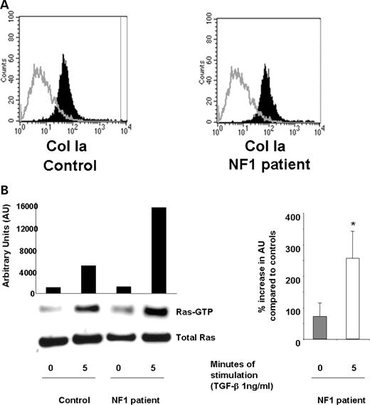 Evaluation of TGF-β-mediated Ras activity and collagen synthesis in fibroblasts from neurofibromas. (A) Fibroblasts from cutaneous neurofibromas and fibroblasts from normal volunteers were examined using an antibody to the surface antigen of Col Ia by using fluorescence cytometry. The population indicated by solid bars represents Col Ia-positive cells and the population indicated by open bars indicates the fluorescence in cells following staining with an isotype control antibody. (B) Ras activity in NF1 and control fibroblasts was examined at basal levels and 5 min following TGF-β stimulation. A representative experiment (left panel) and the mean data from four independent experiments (right panel) are indicated. *P<0.001 comparing Ras-GTP activity in NF1 patients with unaffected controls using the Student's t-test. (C) Fibroblasts from NF1 patients or healthy controls were transduced and collagen synthesis was measured following a 24 h stimulation with TGF-β. Results represent the mean±SEM of three replicates from one of four independent experiments with similar results. *P<0.01 comparing proline incorporation of NF1 Pac transduced cells with control Pac transduced fibroblasts. **P<0.01 comparing proline incorporation of NF1 GRD transduced fibroblasts with NF1 pac and NF1 1276 transduced fibroblasts using the Student's t-test. (D) NF1 fibroblasts were transduced with the indicated constructs and wound healing assays were performed following stimulation with TGF-β. Left panel: results represent the mean±SEM of three replicate dishes from one of four independent experiments with similar results. *P<0.05 comparing the number of unaffected control or NF1 fibroblasts that migrate in response to TGF-β versus vehicle. **P<0.01 comparing migration of NF1 pac transduced fibroblasts with Pac control fibroblasts using the Student's t-test. ***P<0.01 comparing the migration of NF1 GRD transduced fibroblasts with NF1 pac or NF1 1276 transduced fibroblasts using the Student's t-test. Right panel: summary of the relative TGF-β-mediated migration of human NF1 fibroblasts expressing NF1 GAP sequences from four independent experiments.