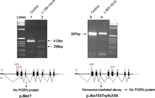  Transcript analyses of novel PGRN splice-site mutations. Agarose gel-electrophoresis of PGRN PCR amplicons obtained from first-strand cDNA prepared from frontal cortex of patients F149-1 (c.138+1G>A; lane 2) and UBC14-9 (c.463-1G>A; lane 4). The analysis of a control individual is included to show the expected transcript lengths for PGRN cDNA exons 0–2 (413 bp, lane 1) and PGRN cDNA exons 4–8 (587 bp, lane 3). For each mutation, a schematic presentation of the predicted splicing of the mutant PGRN transcript is shown. The positions of the mutations are indicated in red, and the locations of the PCR primers are in blue. 