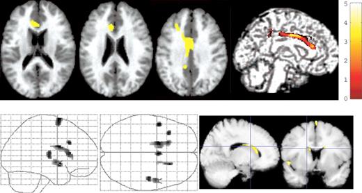  Impact on the brain morphology of the Ser704Cys SNP in healthy subjects. (Upper panel) The SPM {t} is displayed onto T1-weighted MR images. Cys-DISC1 carriers ( n =22) had reduced volumes in the bilateral ACC, cingulate gyrus and the posterior cingulate gyrus compared with ser/ser-DISC1 individuals ( n =86). (Lower panel) The SPM{t} is displayed on a standard maximum intensity projection images and T1-weighted MR images. Ser/Ser-DISC1 individuals demonstrated decreased volumes of the lateral ventricle, interhemispheric fissure and bilateral Sylvian fissure, indicating an expansion of the CSF space in cys-DISC1 carriers. 