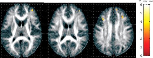  Disruption of white matter integrity revealed by DTI. The SPM{t} is displayed onto a FA map. A significant reduction in FA in the prefrontal white matter was found in the cys-DISC1 carriers ( n =22) when compared with individuals with ser/ser-DISC1 ( n =86). 