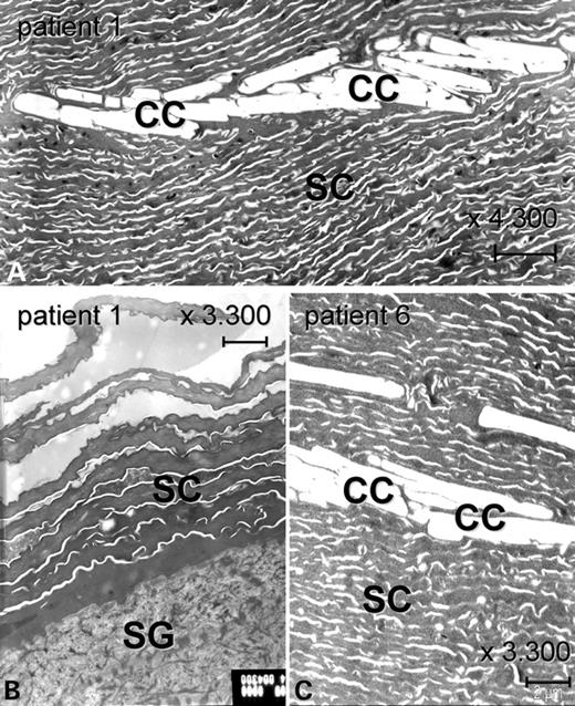 Analysis of ultrastructure in patients with BSI. (A) The massively thickened stratum corneum of the lamellar scaling area of the trunk of Patient 1 displays multiple cholesterol clefts, which are typically observed in ARCI with TGase-1 deficiency. (B) In contrast, the SC of a healthy area (right arm) of Patient 1 has a normal diameter and is not thickened. It does not show any abnormalities. (C) The epidermis of Patient 6 taken at the third day postnatal, when she was still suffering from generalized ichthyosis, also shows a massive SC containing cholesterol clefts. SC: stratum corneum; SG: stratum granulosum; CC: cholesterol clefts. Scale bars: 2 µm.