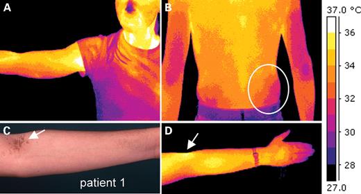 Physiological skin temperature pattern as demonstrated by digital thermal imaging of healthy individuals (n=4). (A) The pseudocolor image of a healthy female volunteer demonstrates well-known temperature zones of arms, elbows, axillae and on the face. (B and D) These temperature images of healthy volunteers were taken after 10 min of acclimatization (RT=22.4°C). (C) The symmetric temperature differences exhibit a striking correlation to the distribution of lamellar scaling as seen, for example, in Patient 1 (compare with Fig. 1) 3, 6 or 10. Regarding the skin temperature zones, one has to conclude that skin areas of more than 33–34°C obviously predispose to the local development of ichthyotic skin.
