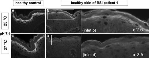 TGase activity test at pH 7.4: 25°C (A, B) versus 37°C (C, D). For control, images on the left side show skin sections of normal skin. Images on the right side including their 2.5× magnification demonstrate TGase activity of the healthy skin of BSI Patient 1. (A, C) Normal skin shows a strong pericellular TGase activity zone in the SG at 25°C as well as at 37°C. (B, D) However, BSI skin exhibits a marked reduction of the fluorescence at 37°C when compared with 25°C indicating a loss of TGase-1 activity under higher temperature in BSI.