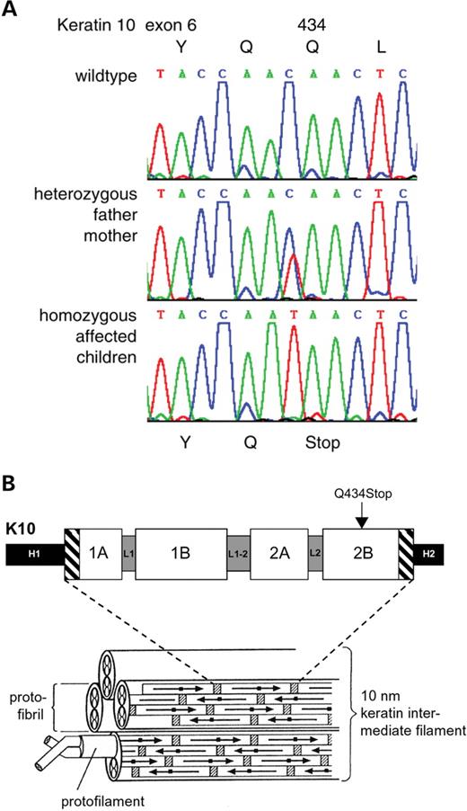 Figure 2. (A) Part of the sequence of exon 6 showing the homozygous mutation p.Q434X in the affected children. (B) Schematic presentation illustrating the position of the PTC within the K10 protein.