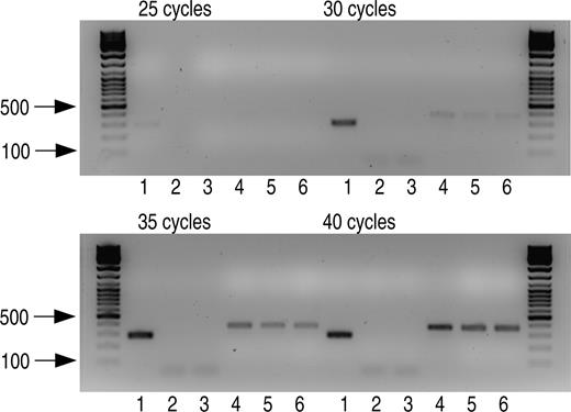 Figure 3. Semi-quantitative RT–PCR of KRT10 mRNA in co-cultures of the affected family members (2,3,5,6) and their mother (1,4) showing complete absence of KRT10 mRNA levels in the homozygous patients. KRT10 PCR products were loaded in lanes 1–3 and s26 PCR products in lanes 4–6.