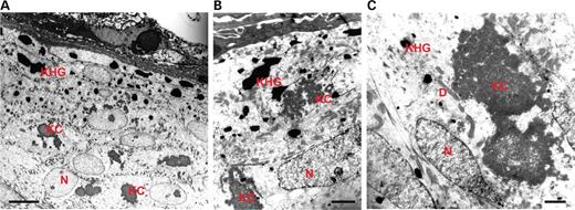 Figure 6. Ultrastructural analysis of skin biopsies of the affected children (A–C) showing coarse keratohyaline granules (KHG) and keratin clumping (KC) in suprabasal keratinocytes. N, nucleus; D, desmosome. Bars: (A) 10 µm; (B and C) 20 µm.