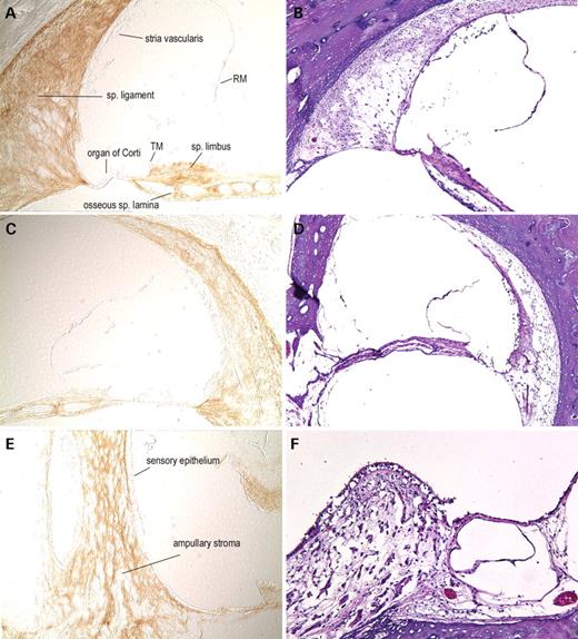 Figure 4. Immunohistochemistry on unaffected human adult (75-year-old male) temporal bone sections with anti-cochlin (A, C, E). No counterstain was used on these sections; serial H&E sections are shown (B, D, F). In the cochlear duct (A, C, ×100), cochlin immunostaining is prominent throughout the spiral ligament, spiral limbus and the channels of the osseous spiral lamina. Adjacent areas of surrounding bony tissues are not stained with the anti-cochlin antibody. Structures of the cochlea shown in this figure, which lack cochlin expression, are the organ of Corti, including the sensory epithelium and tectorial membrane (TM), stria vascularis and Reissner's membrane (RM). Some of these structures show artifactual disruption as a result of paraffin embedding of adult temporal bones. In the posterior crista ampullaris of the vestibular labyrinth (E, ×200), intense cochlin staining is observed in the fibrocytes and stroma underlying the sensory epithelium. The sensory epithelium is completely devoid of any cochlin expression, as was observed in the cochlear duct.