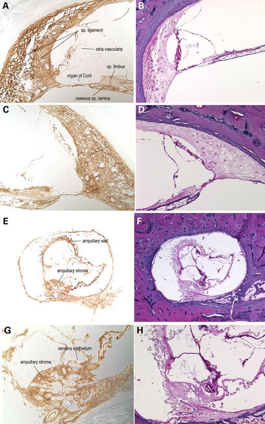 Figure 5. Immunohistochemistry on DFNA9-affected human adult (67-year-old female) temporal bone sections with the anti-cochlin antibody (A, C, E, G). No counterstain was used on these sections; serial H&E sections are shown (B, D, F, H). In the cochlear duct (A, C, ×100), cochlin immunostaining is observed throughout the spiral ligament, spiral limbus and the channels of the osseous spiral lamina. The homogeneous eosinophilic deposits seen on the H&E sections are stained darkly and evenly. The cochlin immunostaining of this acellular material is prominent in the spiral ligament, particularly in the area of insertion into the basilar membrane, the spiral limbus and within the channels of the osseous spiral lamina. The organ of Corti and the stria vascularis are negative for cochlin staining. Some stained tissue underlying the stria vascularis appears to be a part of the spiral ligament that was detached along with the stria. Adjacent areas of surrounding bony tissues do not show any immunostaining. In the posterior ampulla of the vestibular labyrinth (E, ×4; G, ×100), cochlin staining of the ampullary stroma containing the eosinophilic deposits is observed. The collapsed ampullary wall showing prominent thickening and acellular deposition (F) also contains cochlin (E). The sensory epithelium does not show cochlin expression, as seen in the cochlear duct in both DFNA9 and unaffected control inner ears.