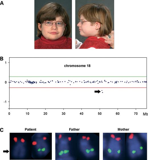  Index patient and results of the molecular cytogenetic analyses. ( A ) Facial appearance of the index patient at the age of 6 years. Note the coarse face with broad nasal bridge, large mouth with bow-shaped upper lip and the slightly dysmorphic ears with anteverted earlobes. Owing to extreme muscular hypotonia, head had to be supported by a parent. ( B ) Profile of chromosome 18 in the index patient showing the microdeletion detected by array-based CGH with an 8k large insert clone DNA microarray. Midpoints of all clones on the chromosome are plotted in genomic order from the p- to the q-terminal arm on the x -axis against their normalized log 2 test to reference ratio on the y -axis. Diagnostic thresholds used were ± 7 standard deviations from the mean, and are given as horizontal lines (red line, lower threshold for deleted clones; green line, upper threshold for duplicated clones). The two deleted clones are indicated by an arrow. ( C ) Deletion confirmation in the index patient by FISH showing a deleted BAC probe RP11-397A16 (from 18q21.2, green) on one homolog of chromosome 18 (arrow). RP11-324G2 (from 18p, red) served as a control probe and showed signals on both chromosomes 18 in the index patient. A combination of the same BAC probes hybridized to her parents' metaphase chromosomes displayed regular signal patterns on both chromosomes 18, thus demonstrating the de novo occurrence of the deletion. 