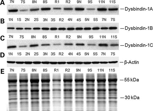 Representative Western blots showing relative amounts of dysbindin-1 isoforms in the DLPFC of schizophrenia (S) cases compared with psychiatrically normal (N) controls matched for age and sex. Reference samples (R1 and R2) were run to assess differences across blots due to variations in experimental conditions. Numbers identify which of the 28 matched pairs tested are shown. Twenty micrograms/lane of protein were electrophoresed, transferred to PVDF membrane and probed with anti-dysbindin-1 antibodies with Oxford PA3111 in (A and C) and with UPenn 331 in (B). Blots were processed for β-actin (D) or MemCode staining (E) to control for variations in protein levels due to sample degradation (during tissue storage or lysate preparation), gel loading and/or efficiency in membrane transfer.