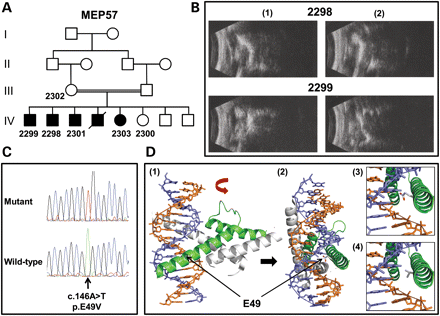 Analysis of MEP57. (A) Pedigree structure for family MEP57. The individuals from whom DNA is available are numbered. (B) B-scan ultrasound examination of the right (1) and left (2) eyes from patients 2298 (aged 33 years) and 2299 (aged 24 years). Note a reduced axial length (microphthalmia) together with disorganization of the vitreous and chronic retinal detachments. (C) Sequence chromatograms highlighting the ATOH7 mutation in an affected patient from MEP57 and the corresponding wild-type sequence from a normal individual. (D) Molecular modelling of the bHLH domain of human ATOH7 wild-type and p.E49V. Ribbon representation of the bHLH domain in ATOH7 (in green) dimerized with the transcription factor E2-alpha (in grey) and bound to double-stranded DNA (purple and orange helix) as a lateral (1) and, following a 90° rotation, frontal (2) view. Note residue E49 in the wild-type sequence is in close connection with the DNA helix. The proximity of the E49 (3) and V49 (4) residues to the DNA helix shows that the V49 is more distant and so is less likely to interact with the DNA.