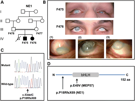 Analysis of NE1. (A) Pedigree structure for family NE1. The individuals from whom DNA is available are numbered. (B) Current photos of the anterior segment of affected family members F475 (aged 16 years) and F476 (aged 14 years). Detailed views of the right eye of patients F475 (1) and F476 (2) as well as the left eye of patient F476 (3) are shown. Note reduced globe size (microphthalmia), diffuse corneal haze with additional superficial, predominantly interpalpebral, discrete opacity secondary to calcium deposition (band keratopathy). The observed ocular deviation (strabismus) is a result of the poor vision. There are no signs associated with significant anterior segment inflammation. (C) Sequence chromatograms highlighting the ATOH7 mutation in an affected patient from NE1 and the corresponding wild-type sequence from a normal individual. (D) Diagrammatic representation of ATOH7 (NP_660161). The position of the bHLH domain and the mutations relative to the full-length 152 amino acid protein are shown.