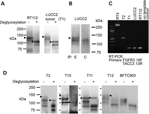 (A) Western blot shows the presence of a high-molecular weight form of FGFR3 (arrowheads) in the tumour from which LUCC2 was derived (T1), and that it is the same size as that seen in RT112 (arrowheads), with and without deglycosylation. (B) Immunoprecipitation of LUCC2 protein with antibodies detecting epitopes in the extracellular (E) or cytoplasmic (C) regions of FGFR3 and detection with FGFR3 antibody B9, which recognizes amino acids 25–124. A high-molecular weight form (arrowhead) is precipitated by E but not C antibody. Because of the lower FGFR3 expression, 20 times more total protein was used for the LUCC2 IP than for the cell lines shown in Fig. 1. (C) RT-PCR using primers from FGFR3 exon 18 and TACC3 exon 13 shows fusion transcripts in tumour samples T1 and T2 and cell lines RT4, RT112 and LUCC2. (D) Tumours T2, T10 and T11 retain high-molecular weight forms of FGFR3 after deglycosylation (arrowheads). Tumour T12 shows a high-molecular weight form of FGFR3 (arrowhead), but this is reduced to the normal molecular weight by deglycosylation. Cell line BFTC905 shows the expected result for untranslocated FGFR3.