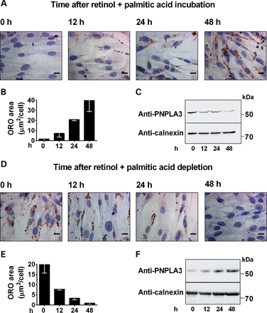 Intracellular lipid accumulation modulates PNPLA3 expression in pHSCs. (A) Lipid droplet content visualized by ORO-staining in pHSCs incubated with retinol and palmitic acid for the indicated times. (B) ORO-stained area quantified by Biopix. (C) Immunoblot showing PNPLA3 expression in pHSCs under conditions described in (A). (D) Lipid droplet content visualized by ORO staining in pHSCs incubated with retinol and palmitic acid for 48 h and then in medium without retinol-palmitic acid for the indicated times. (E) ORO-stained area quantified by BioPix. (F) Immunoblot showing PNPLA3 expression in pHSCs under conditions described in (D). Scale bars: 10 µm.