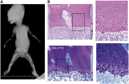 Radiographic phenotype and growth plate histology in SRPS case R98-277B. (A) AP fetal radiograph illustrating the undermineralized skull, moderately short ribs, flat acetabular roof and shortened long bones with mild femoral/humeral bending. (B) Growth plate histology comparing the control (top) and SRPS case (bottom) demonstrating irregularity of the border between the hypertrophic zone (H) and bone (B) and the very short hypertrophic zone (the boxed area is expanded on the right). Scale bars are 100 µM.