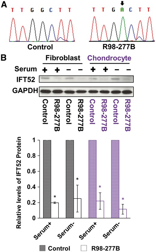 Consequences of IFT52 mutations. (A) Sequences of RT-PCR products derived from IFT52 mutant cells, demonstrating that only products of the missense allele with the c.595G > A mutation were found. The nucleotide change is indicated with a black arrow. (B) Immunoblotting revealed IFT52 protein reduction in the lysates of IFT52 mutant cultured fibroblasts and chondrocytes under both serum replete and serum restricted conditions as compared with controls. Below the Western blots, IFT52 abundance in SRPS cells was normalized to control cells, demonstrating a statistically significant reduction in IFT52 in SRPS cells (n = 3, *P < 0.05).