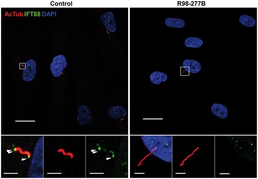 IFT88 distribution in cilia. Immunofluorescence microscopy of SRPS and control ciliated cells stained with mouse anti-acetylated α-tubulin (red) and rabbit anti-IFT88 (green). The IFT88 signal was enriched at the basal bodies (single arrowhead) and tips of cilia (double arrowheads) in controls while in SRPS cells it could not be detected above background. Boxed regions are expanded at the bottom and separated into single signal panels with anti-acetylated α-tubulin (red) and anti-IFT88 (green). Scale bars represent 20 μm in the upper panels and 1 μm in the insets.