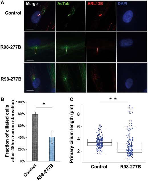 Cilia abundance and ciliary length. (A) Ciliary axonemes and basal bodies of SRPS fibroblasts were stained using mouse monoclonal anti-acetylated α-tubulin (green) and rabbit anti-ARL13B (red) antibodies, respectively. Representative cells with either elongated or shortened cilia as compared with control are shown. Scale bars represent 10 μm. (B) The fraction of ciliated cells in the SRPS case (40.2%) was significantly decreased compared with the control sample (79.2%). Cilia were enumerated from 324 patient cells and 287 control cells observed in four randomly sampled regions; *P = 0.0002. (C) Average cilia length in the SRPS case (2.89 μm) was significantly shorter than cilia length in control cells (3.51 μm), **P = 6.312e-05, and there was also a wider distribution of cilia lengths among SRPS cells. The cilia length data were calculated from 155 ciliated SRPS cells and 159 ciliated control cells.