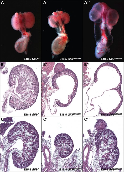 Whole-mount Gli3Δ699/Δ699 (A′ and A″) urogenital systems at E18.5 demonstrate marked hydroureter and hydronephrosis compared with in Gli3+/+ (A) controls. H&E tissue sections of Gli3Δ699/Δ699 (B′ and B″) kidneys demonstrate marked dilation of the kidney, renal hypoplasia (B′) and a duplicated collecting system (B″) in a subset of kidneys when compared with controls (B). Hydroureter and hydronephrosis was absent at E15.5 in Gli3Δ699/Δ699 (C′ and C″) kidney tissue sections; however, they were still marked by renal hypoplasia (C′) and a duplicated collecting system (C″) in a subset of kidneys when compared with controls (C).