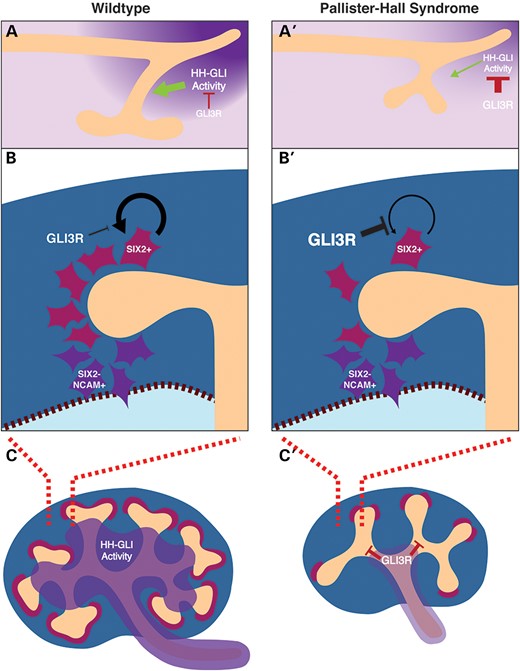 A model is presented whereby GLI3R inhibits HH signaling activity in the caudal nephric duct that is required for ureteric outgrowth (A and A′). When GLI3R is ectopically activated in the nephrogenic mesenchyme, nephrogenic mesenchyme self-renewal is inhibited (B and B′) leading to a nephron deficit. Finally, when GLI3R is ectopically activated in the ureteric bud lineage, branching morphogenesis is inhibited (C and C′) leading to renal hypoplasia.