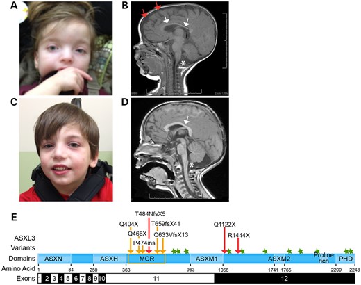 Characterization of pathogenic truncating ASXL3 variants. (A) Facial characteristic of proband I at age 36 months showing low-set ears, broad nasal bridge, sparse arched eyebrows, downslanting palpebral fissures and broad forehead with periorbital fullness. (B) Brain MRI of proband I showing cerebellar vermal hypoplasia (single star), corpus callosum hypoplasia (white arrows), increased subdural space (two red arrows) and decreased white matter volume. (C) Proband II has a small chin, downslanting palpebral fissures and borderline low-set ears. (D) Proband II showing cerebellar vermal hypoplasia (single star) and a shortened corpus callosum (white arrow). (E) Schematic illustration of the main functional units of ASXL3 and pathogenic variants. Novel ASXL3 variants are depicted by red arrows. Previously described truncating ASXL3 variants (orange arrows cluster in the MCR, orange box). Missense ASXL3 variants identified in individuals with Autism spectrum disorder (green stars). ASXL3 functional units are shown with corresponding amino acids. ASXL3 exons 11 and 12 are 1.9 and 3.7 kb in length, respectively, and comprise ∼5.6 kb of the ∼6.8 kb ASXL3 open reading frame.