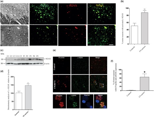 γ-H2AX accumulates in motor neurons from patients carrying the C9orf72 repeat expansion (A) Paraffin-fixed human spinal cord sections from C9orf72 patients and controls were subjected to immunohistochemistry using anti-phosphorylated (γ-H2AX) and anti-SMI32 antibodies. SMI32 immunostaining was used to locate motor neuron cell bodies in both ALS patients and controls. Accumulation of phosphorylated γ-H2AX (pSer139) foci was detected in motor neurons in the ventral horn regions of C9orf72 patients. Scale bars: 10 μm, (B) Quantitative analysis of accumulated γ-H2AX images in (A), revealed that significantly more motor neurons with γ-H2AX (42.45% increase) were present in C9orf72 patient tissues in comparison to controls. At least 60 motor neurons were scored from each group. Tissues from two C9orf72 patients and six controls were examined (P6 and P7); (C1-C6) (Table 1). Data are represented as mean ± SEM; **P < 0.001 versus controls by unpaired studentt test. (C) Human spinal cord homogenates (30 µg) were subjected to western blotting using anti-γ-H2AX antibodies. Blots were reprobed with anti-β-actin antibodies as a loading control. (D) Densitometry quantification of blots in (C) relative to β-actin revealed that the levels of accumulated γ-H2AX were significantly elevated in patients bearing the C9orf72 repeat expansion compared to controls. (30.6% increase; P < 0.001). Ten patients and ten controls were examined in total (Table 1). (E) Human spinal cord tissues (paraffin-fixed) from ALS patients and control individuals were labelled for C9orf72 using FISH and immunohistochemistry using γ-H2AX antibodies. These studies revealed that DNA damage was present in ALS motor neurons expressing the C9orf72 repeat expansion. (F) Quantification of images shown in (E), represented as a mean +/- SEM, *P < 0.05 by t-student test. 20–30 motor neurons were scored in each group from three individuals. Significantly more motor neurons displayed DNA damage and C9orf72 foci in ALS patients compared to controls.