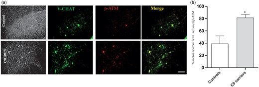 Significantly more motor neurons express phosphorylated ATM in C9orf72 patients (A) Paraffin-fixed human spinal cord sections were subjected to immunohistochemistry using anti p-ATM (phospho S1981) antibodies, and anti-vCHAT antibodies to locate motor neurons in the ventral horn regions. More motor neurons with activated, p-ATM were detected in C9orf72 patients compared to controls. Scale bar 10μm. (B) Quantitative analysis of images in (A) revealed that significantly more motor neurons with activated p-ATM were present in C9orf72 patients in comparison to control tissues (52% increase; P < 0.05). At least 60 motor neuron cells were scored from each group. Data are represented as mean ± SEM; *P < 0.05 versus controls by unpaired student-t test. A total of two C9orf72 patients and two controls were examined (P6 and P7); (C1-C6) (Table 1).