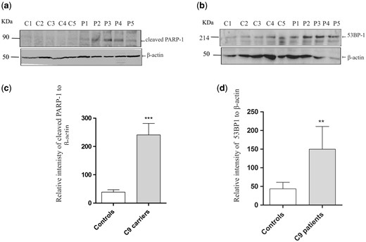 Markers of the DDR are elevated in C9orf72 patients compared to controls (A,B) Human spinal cord homogenates (30 µg) were subjected to western blotting using anti-cleaved PARP-1 and anti-53BP1 antibodies. Blots were reprobed with anti-β-actin antibodies as a loading control. (C,D) Densitometry quantification of blots relative to β-actin revealed that the levels of cleaved PARP-1 and 53BP-1 were significantly elevated in patients bearing the C9orf72 repeat expansion (84% increase; P < 0.0001) (70% increase; P < 0.001). A total of ten C9orf72 and ten control (Table 1) spinal cord lysates were examined and three different repeats of each blot were performed. Data are represented as mean ± SEM; ***P < 0.0001, **P < 0.001, versus controls using unpaired student-t test.